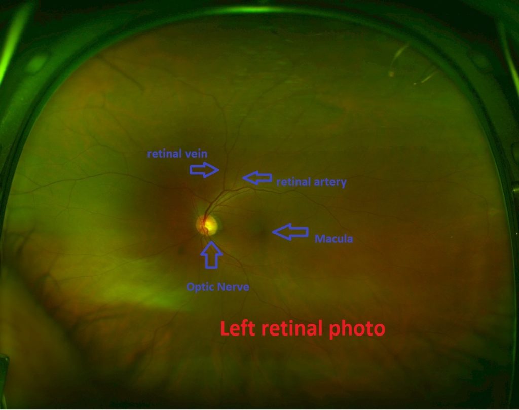 normal retina premium practice eye