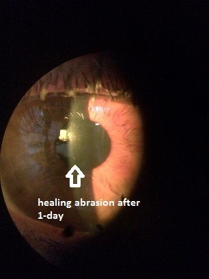 corneal_abrasion_1_day.jpg