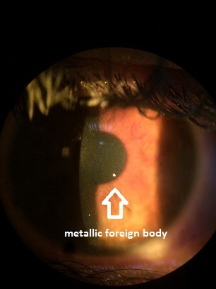corneal_foreign_body.jpg