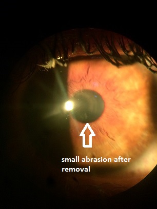 corneal_foreign_body_after_removal.jpg